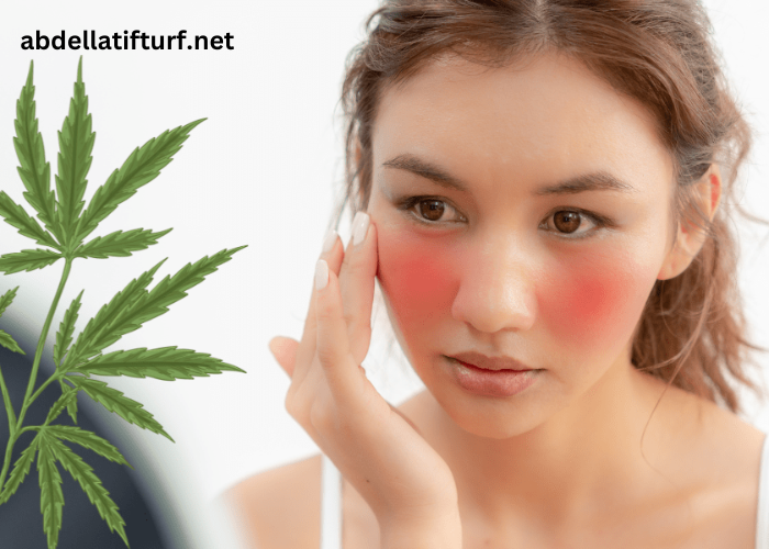 How CBD Day Cream Helps With Rosacea and Inflammation